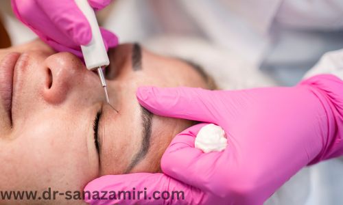 بلفاروپلاستی چیست؟