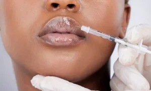 بعد از تزریق ژل لب میشه بالم لب زد؟
