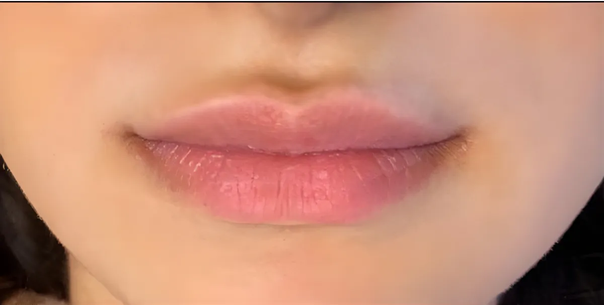 عکس قبل از تزریق لب روسی