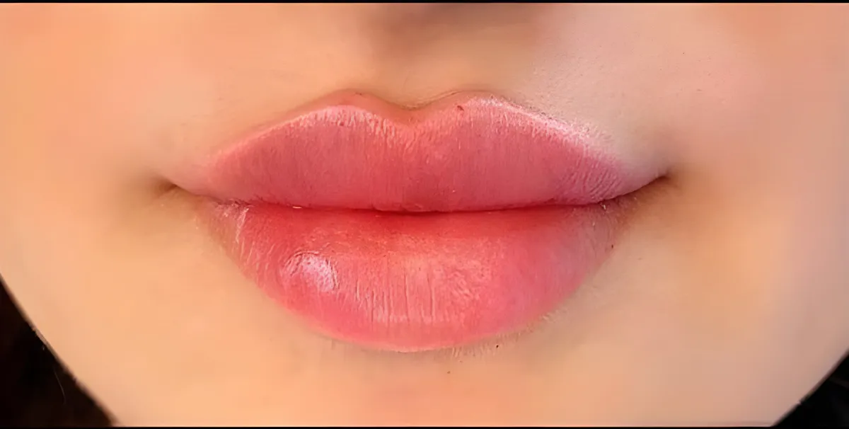 عکس بعد از تزریق لب روسی