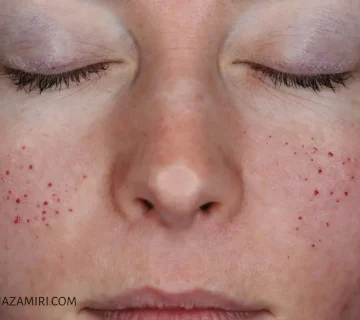 بررسی تخصصی فواید و مضرات میکرونیدلینگ صورت