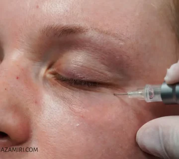 کربوکسی تراپی زیر چشم چه عوارضی دارد؟