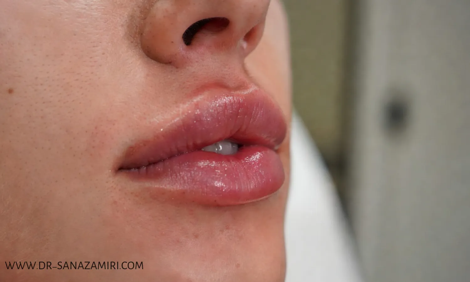 بعد از تزریق ژل لب می توان سونا یا حمام داغ رفت؟